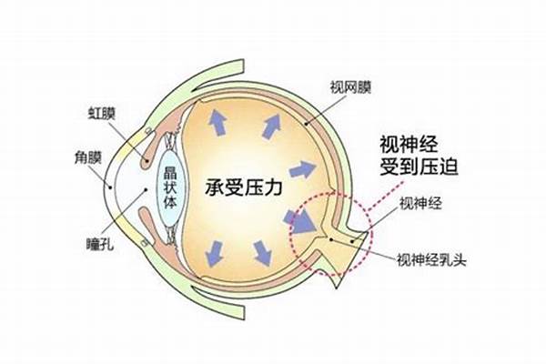 眼压高怎么缓解